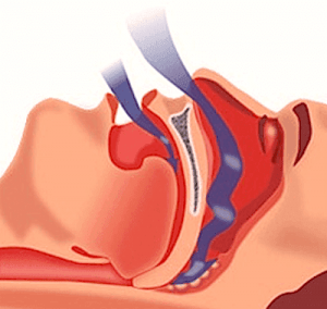 Surgical Procedures for Snorers