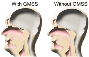 how good morning snore solution works