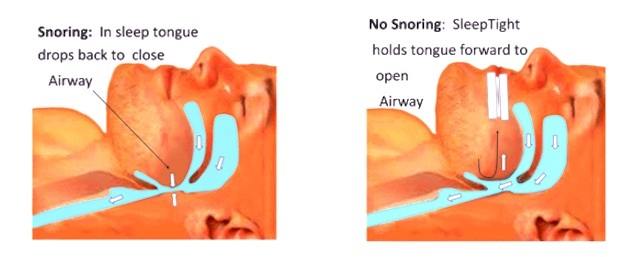 demo sleep tight opening airway How SleepTight Mouthpiece Works
