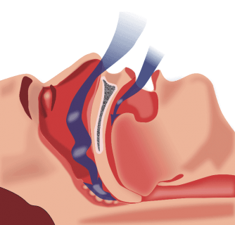 nasal cone diagram